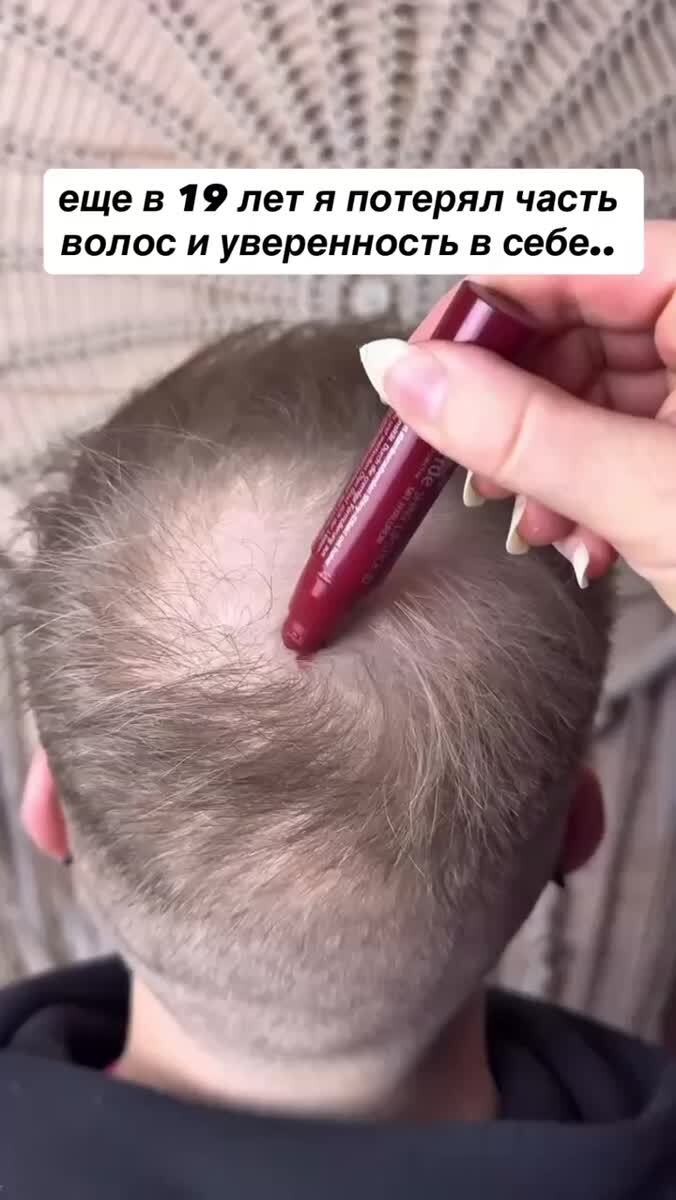 Вот с такой лысой макушкой ко мне пришел клиент..😭Его спасла сыворотка против выпадения волос с биотином на WB - https://wildberries.ru/catalog/0/search.aspx?search=WW407258на OZON - https://ozon.ru/t/zMx04ue✔️Подходит для всех типов волос, борится против